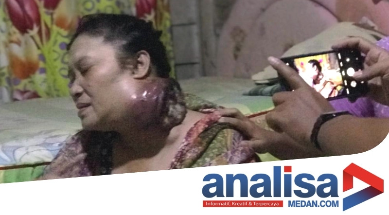 Tak Punya Biaya, Ibu 2 Anak Penderita Kanker Leher di Sidimpuan Kini Hanya Tergeletak Pasrah