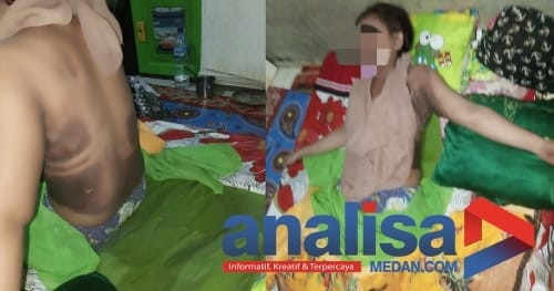 Selingkuhannya Selingkuh, Oknum Sekdes di Sidimpuan Bakar Teman Wanitanya Pakai Pertalite